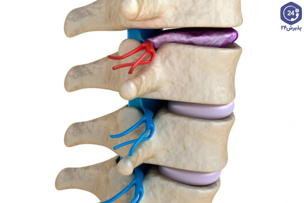 علائم بیماری دژنراتیو ستون فقرات