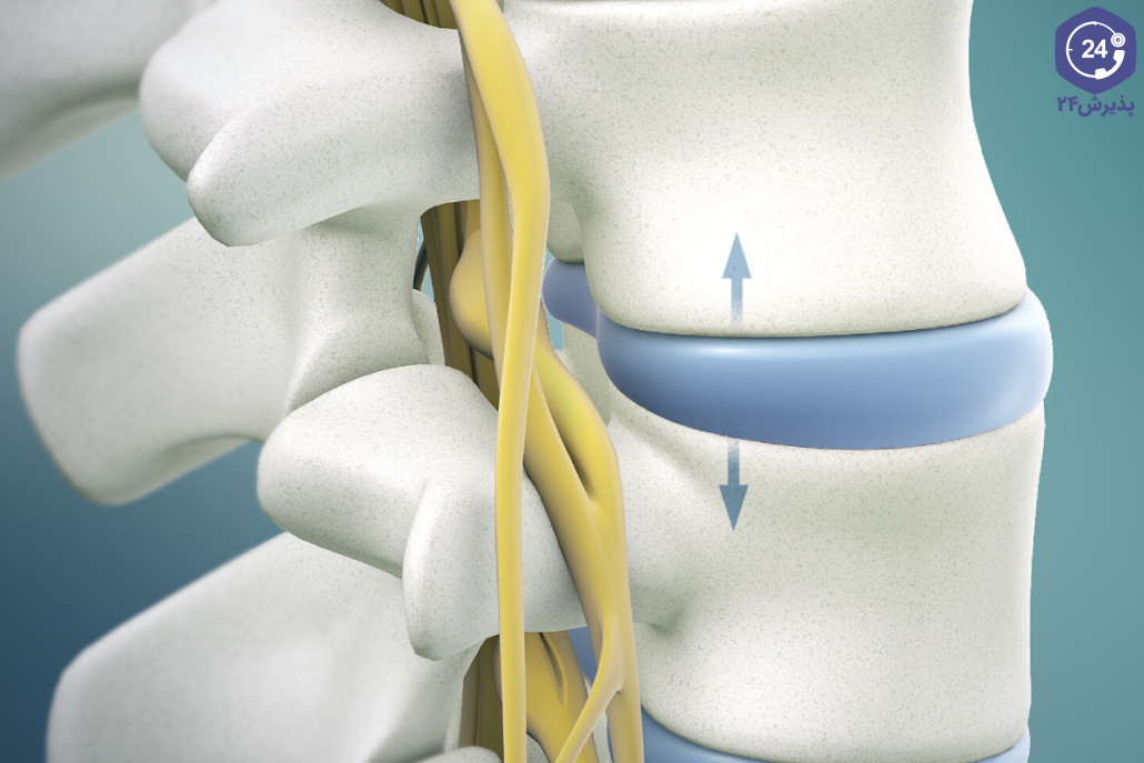 درمان دژنراتیو ستون فقرات
