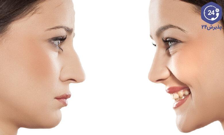 معیار بینی زیبا