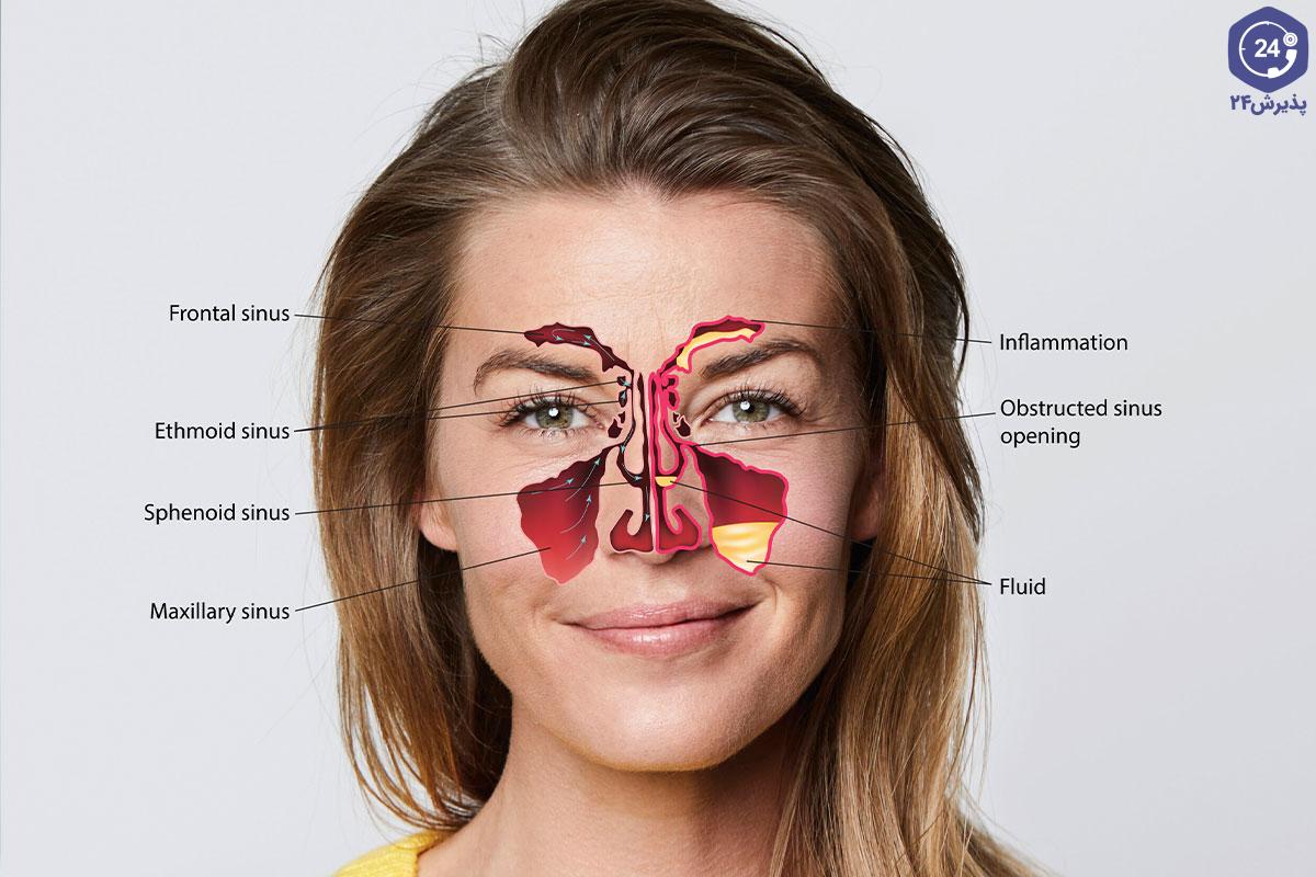 تفاوت سینوزیت و آلرژی (حساسیت)