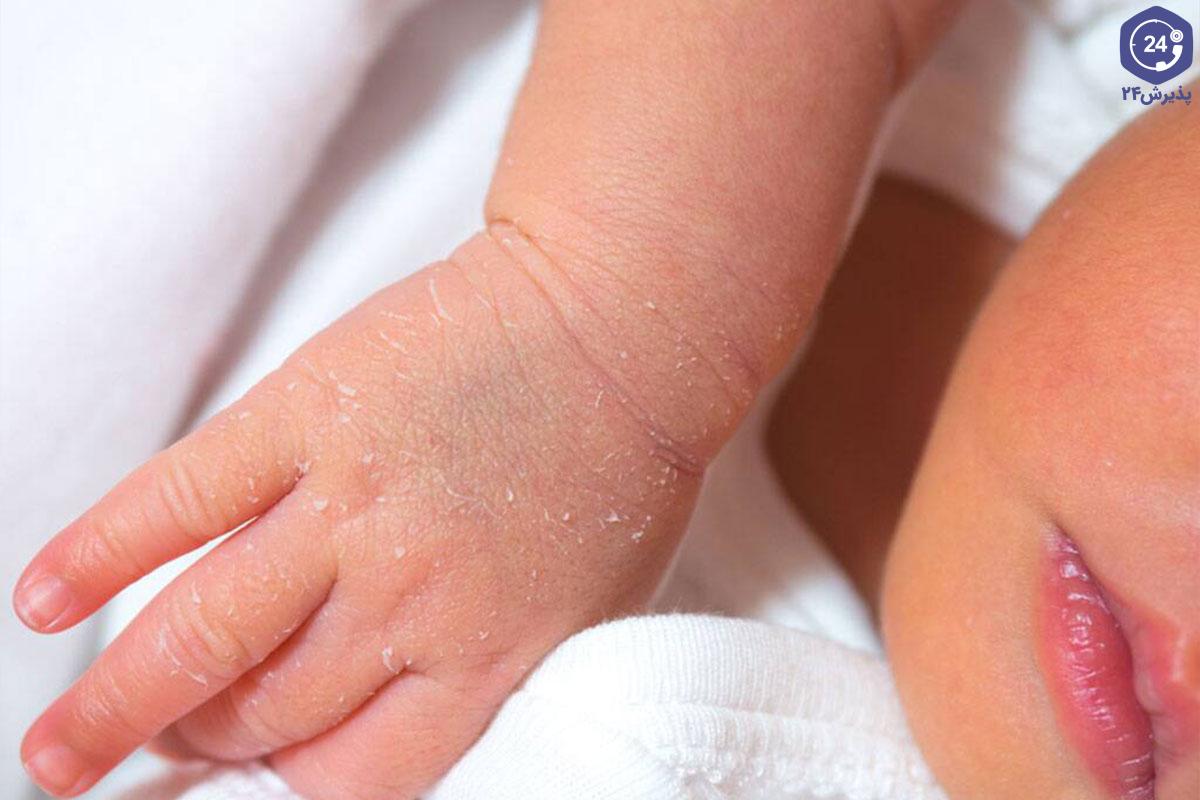 درمان پوسته ریزی نوزادان