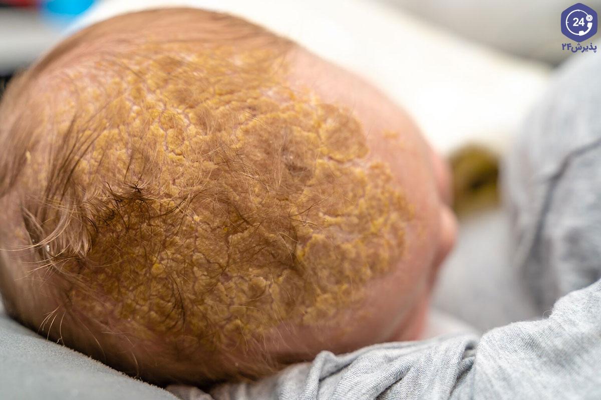 درمان خانگی پوست ریزی سر نوزاد