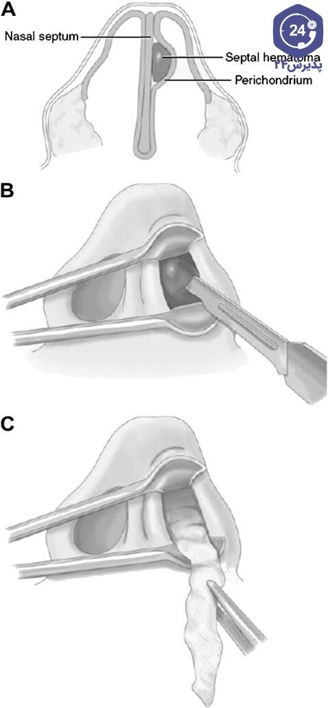 جراحی هماتوم بینی