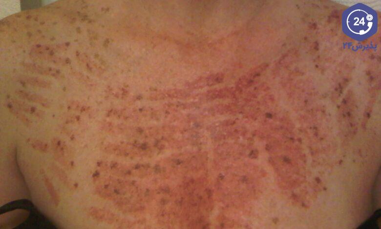 سوختگی ناشی از لیزر