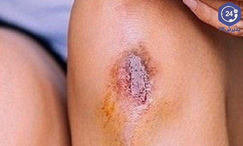 عفونت سوختگی