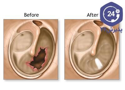 میزان شنوایی بعد از تمپانوماستوئیدکتومی به مرور بهبود می‌یابد.
