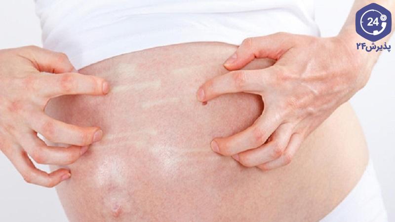 خشکی پوست شکم در بارداری