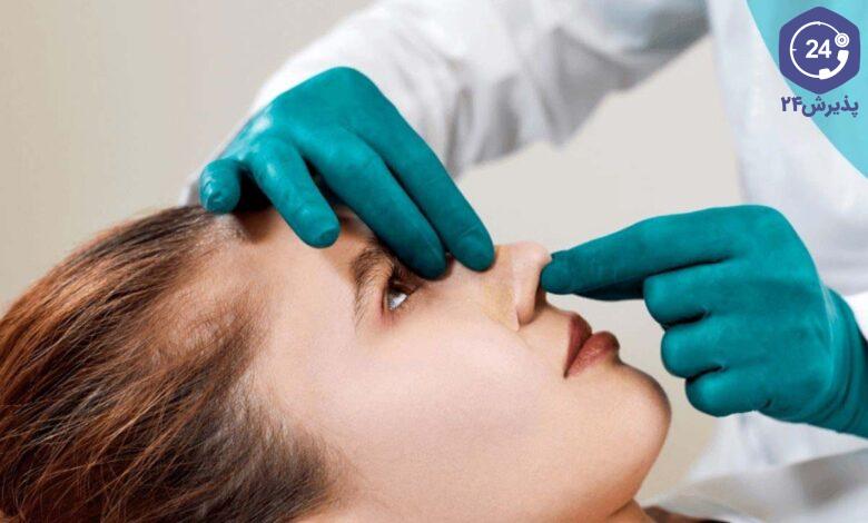 افتادگی نوک بینی بعد از عمل