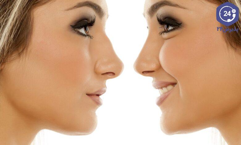 تفاوت جراحی بینی باز و بسته