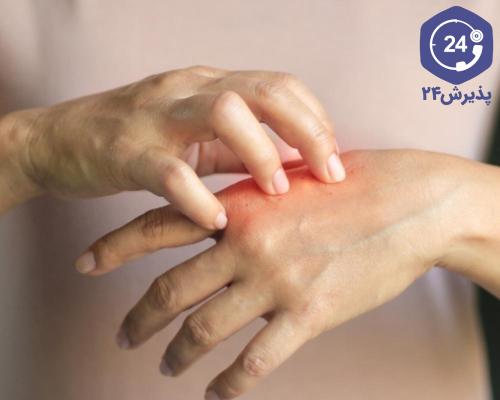 علت خشکی پوست دست چیست؟ درمان خشکی پوست دست