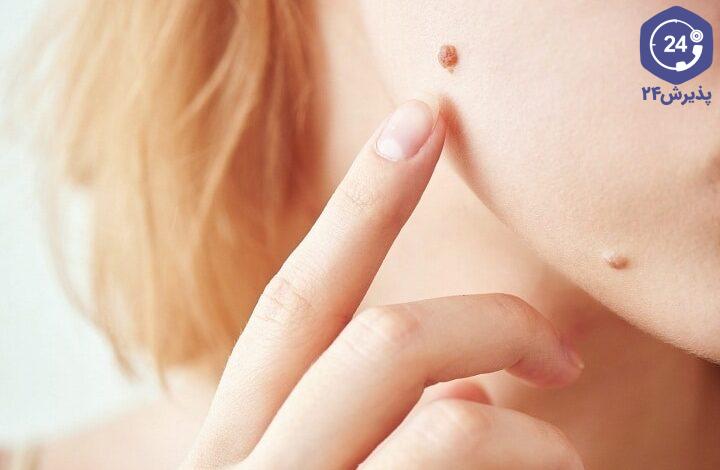 جراحی برداشتن خال گوشتی