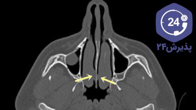 چسبندگی بینی بعد از عمل جراحی