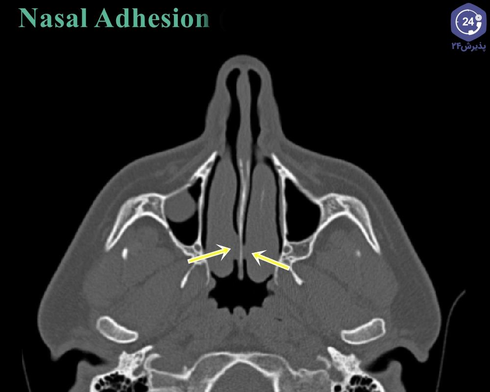 چسبندگی بینی بعد از عمل جراحی