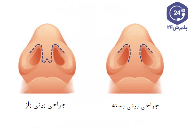 تفاوت عمل زیبایی بینی باز و بسته