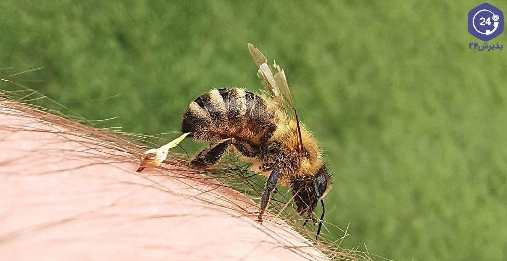 آلرژی به نیش زنبور