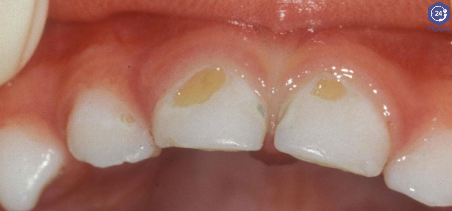 عکس پوسیدگی دندان کودکان