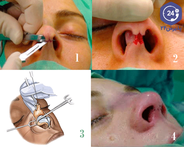 نحوه انجام جراحی بینی به روش باز