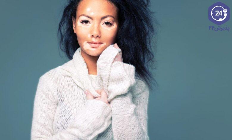 درمان خانگی پیسی یا برص