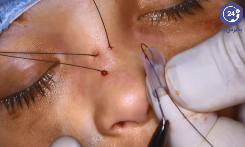 فرورفتگی پل بینی بعد از عمل
