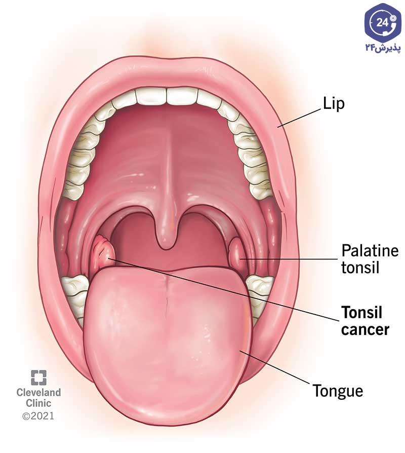 مقایسه لوزه مبتلا به سرطان (سمت چپ) و لوزه سالم (سمت راست)