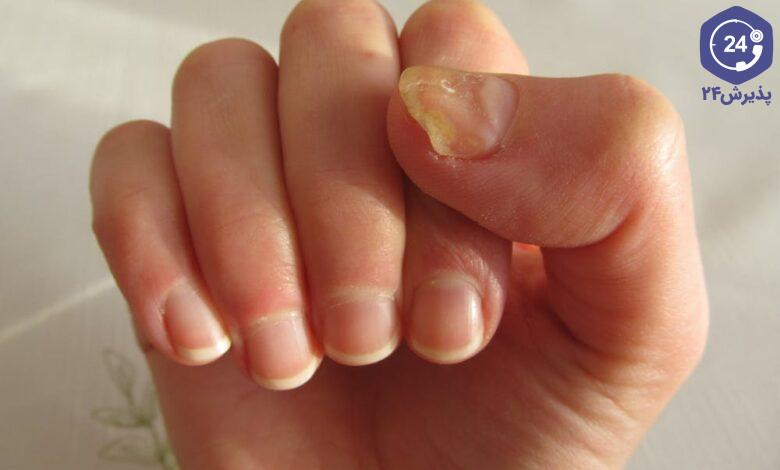 قارچ ناخن کاشت شده