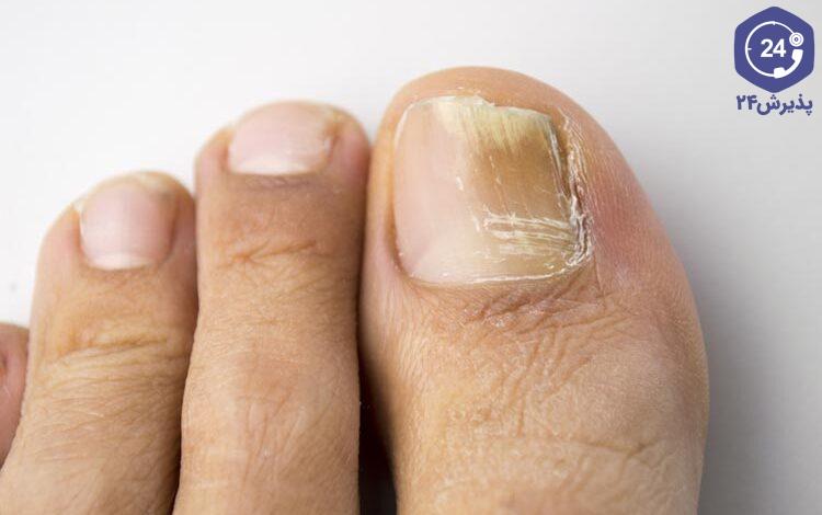 درمان خانگی قارچ ناخن