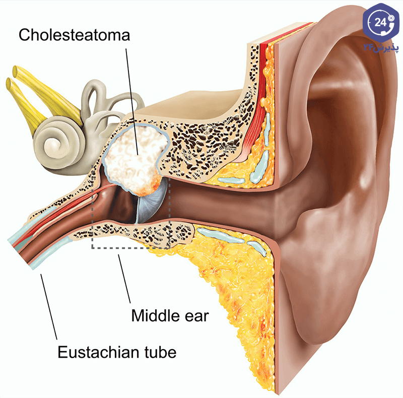 کیست گوش میانی