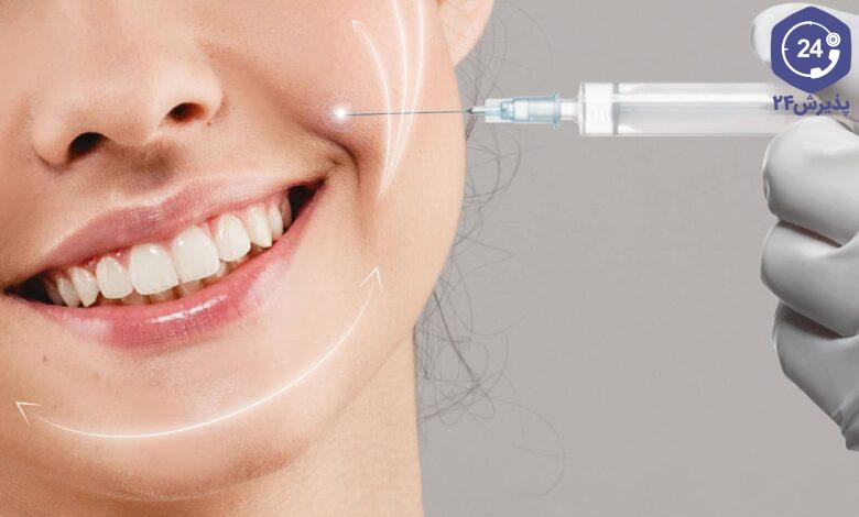 فیلر خط خنده