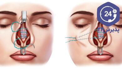 بخیه داخل بینی پس از عمل