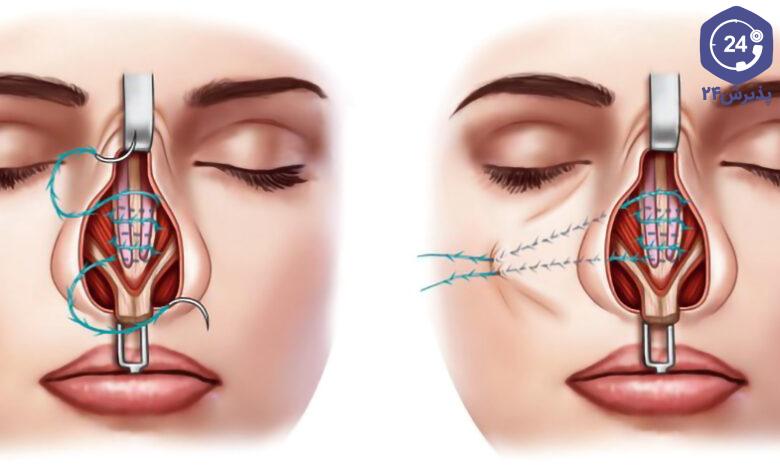 بخیه داخل بینی پس از عمل