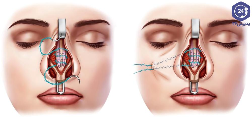 بخیه داخل بینی پس از عمل