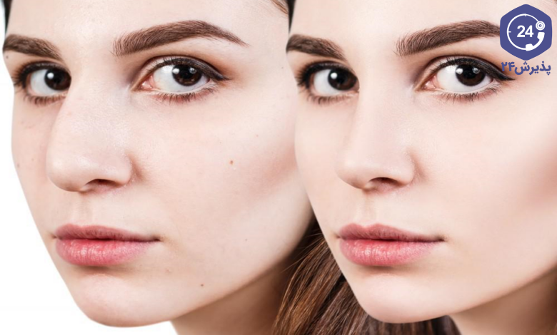 جراحی بینی طبیعی