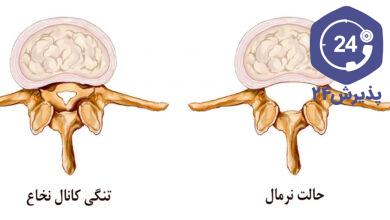 تنگی کانال نخاعی گردن