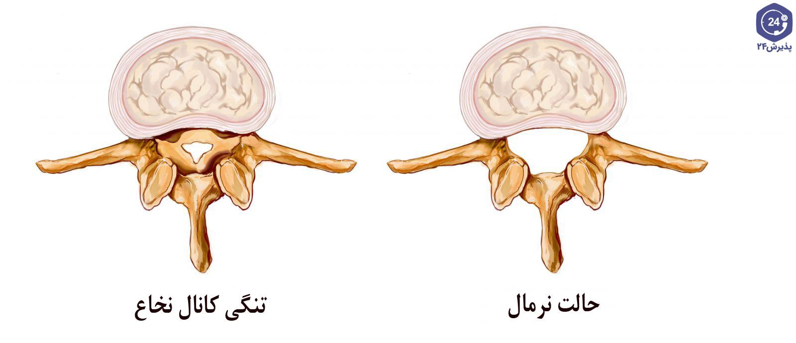 تنگی کانال نخاعی گردن