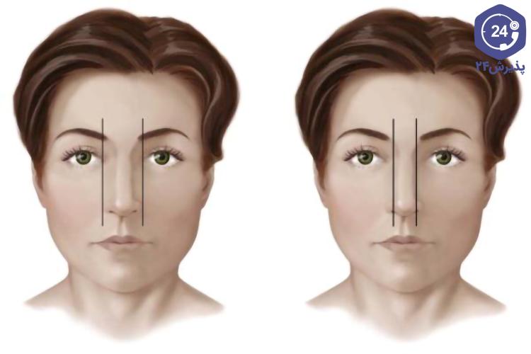 علل اصلی کج شدن نوک بینی پس از جراحی