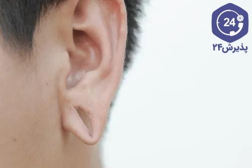 انواع جراحی‌های درمان پارگی سوراخ لاله گوش